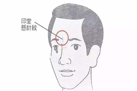 印堂有疤痕对人会有什么影响 它会带来厄运吗 图片1