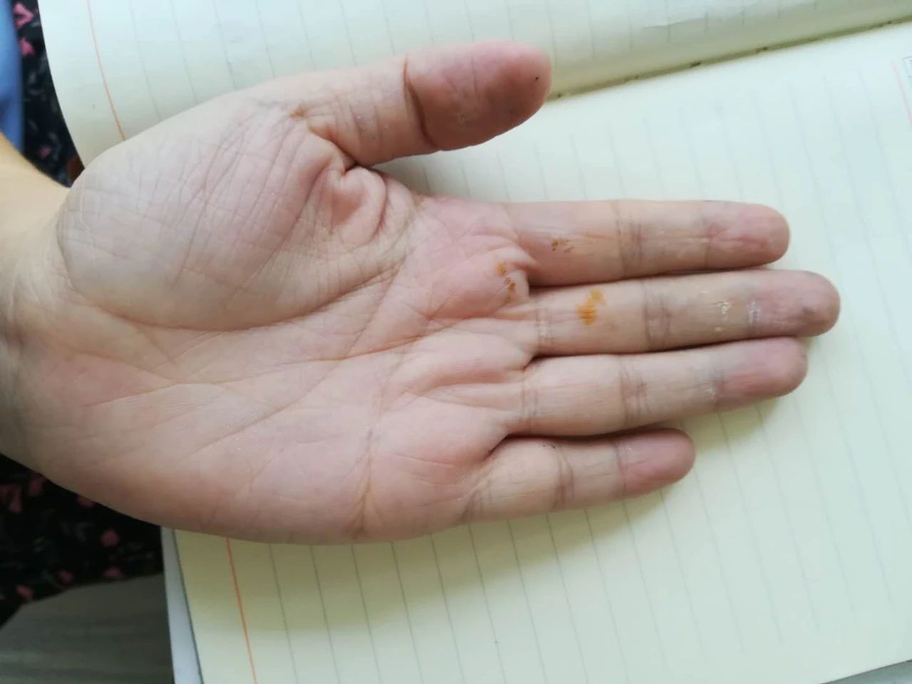 手诊分析：大鱼际青筋暴露的原因 图片1