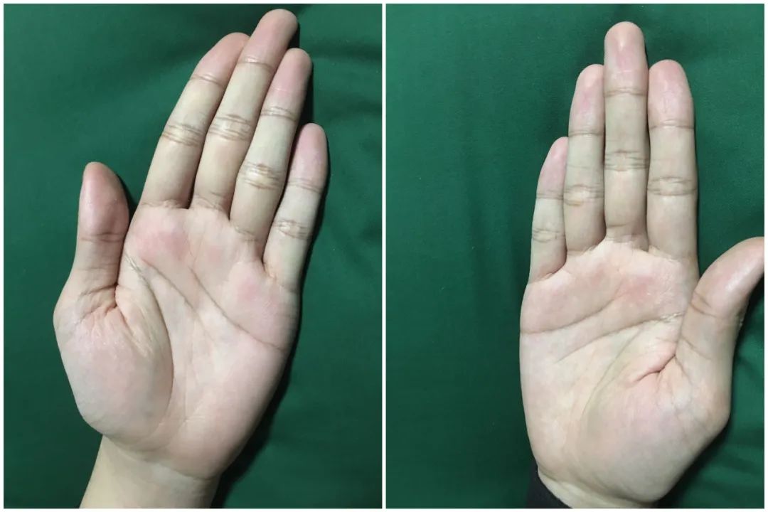 手相面相上常见的纹路和痣的解答 图片11
