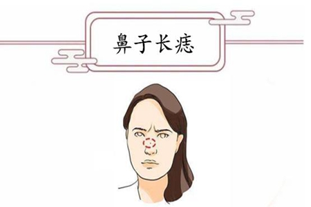 鼻头有痣好吗 它会带来坏运吗 图片1