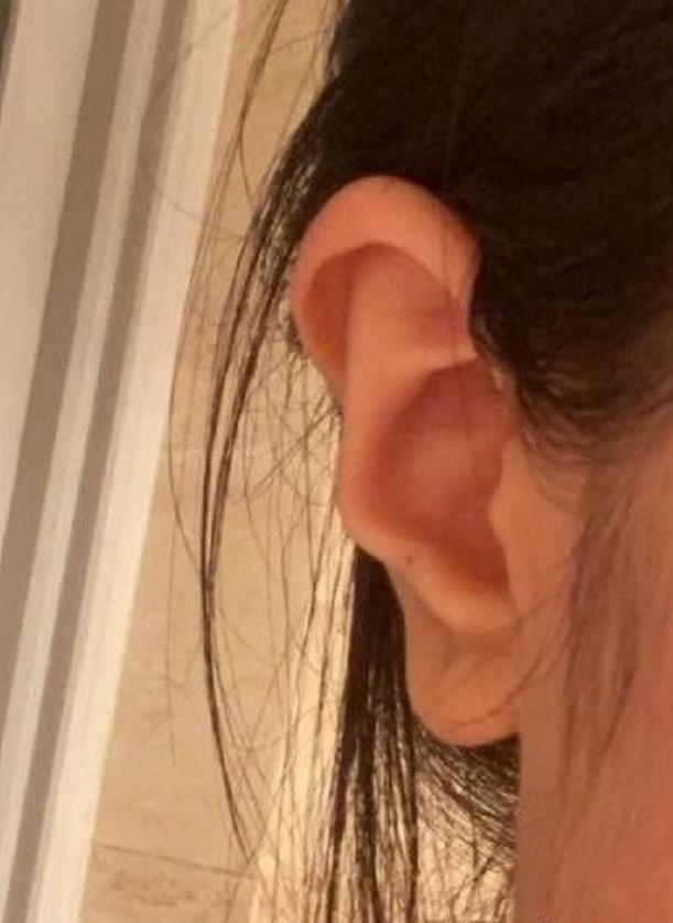 耳相：耳骨反耳朵有缺口，耳垂有横纹有什么说法 图片1