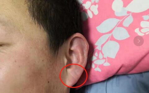 耳相：耳骨反耳朵有缺口，耳垂有横纹有什么说法
