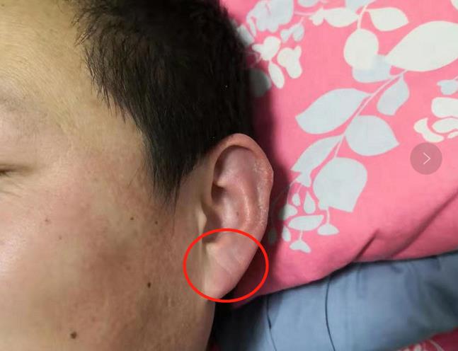 耳相：耳骨反耳朵有缺口，耳垂有横纹有什么说法 图片5