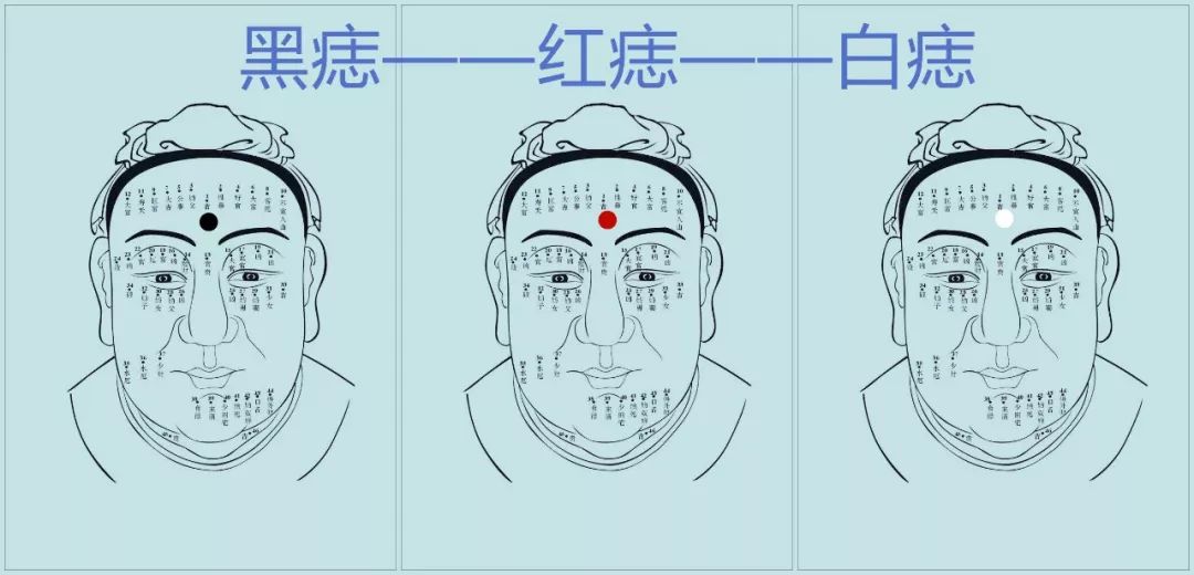 如果你脸上有这种招财痣,无论如何都别点掉 图片2 如果你脸上有这种招财痣,无论如何都别点掉 图片1