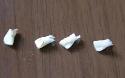 梦见牙齿掉了是什么征兆 是成长还是老去吗