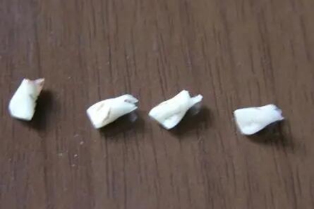 梦见牙齿掉了是什么征兆 是成长还是老去吗 图片17