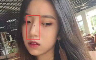 鼻梁上有痣的人会有福运吗? 图片2 鼻梁上有痣的人会有福运吗? 图片1